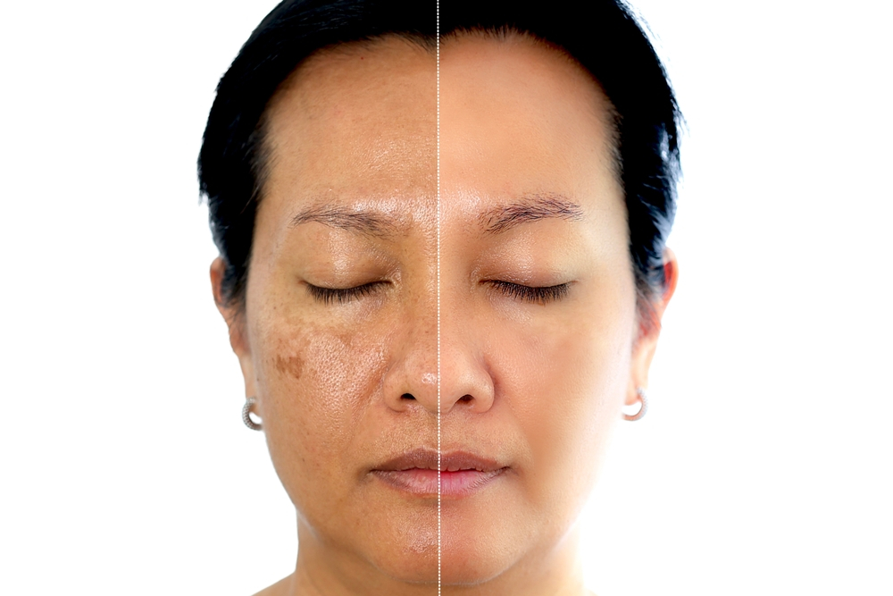 Common Causes of Skin Pigmentation and How to Treat Them | TechPlanet