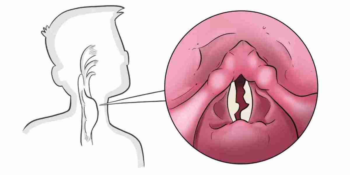 Harmony Restored: Advances in Vocal Cord Paralysis Treatment