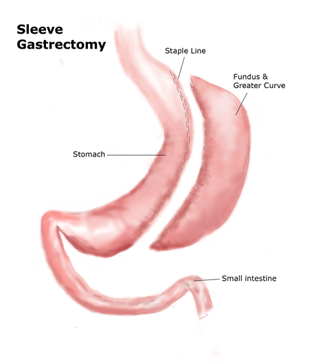 Sleeve Gastrectomy | Obesity Treatment Procedure [2024] | Nexus Surgical