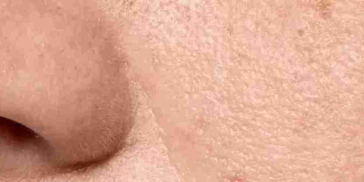 What Are The Effective Ways To Minimize The Open Pores?