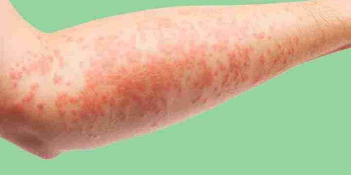 Papular Eczema vs. Atopic Dermatitis: Clearing Up the Confusion