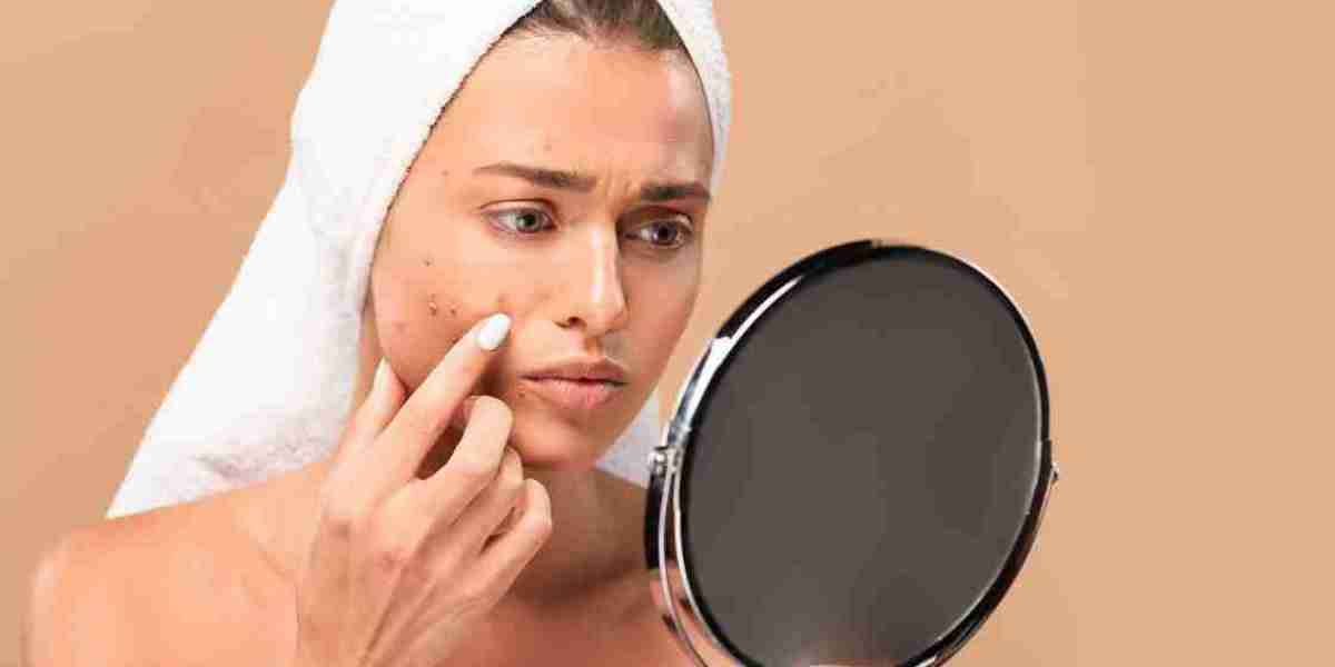 All About Acne: Causes and Treatment Discussed by Dermatologist