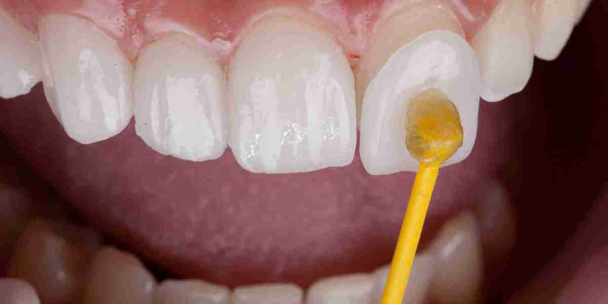 Dental Veneers for Youthful Smiles