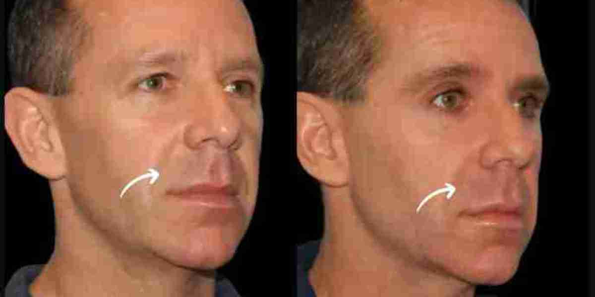 Is Sculptra Fillers the Future of Fillers? Dubai Best Plastic Surgeon weighin