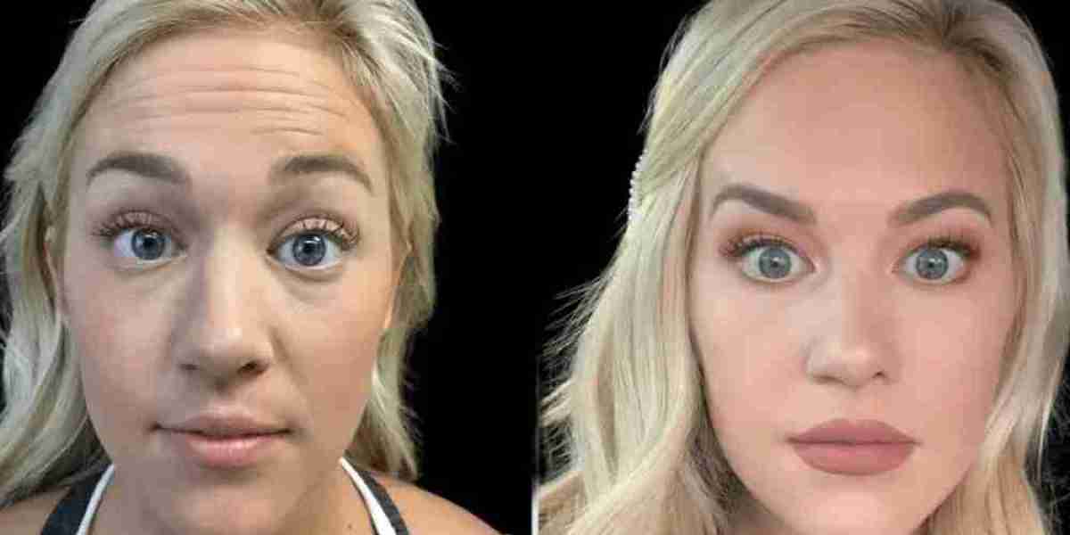 How to Combine Skincare with Botox Treatment in Dubai for Maximum Results
