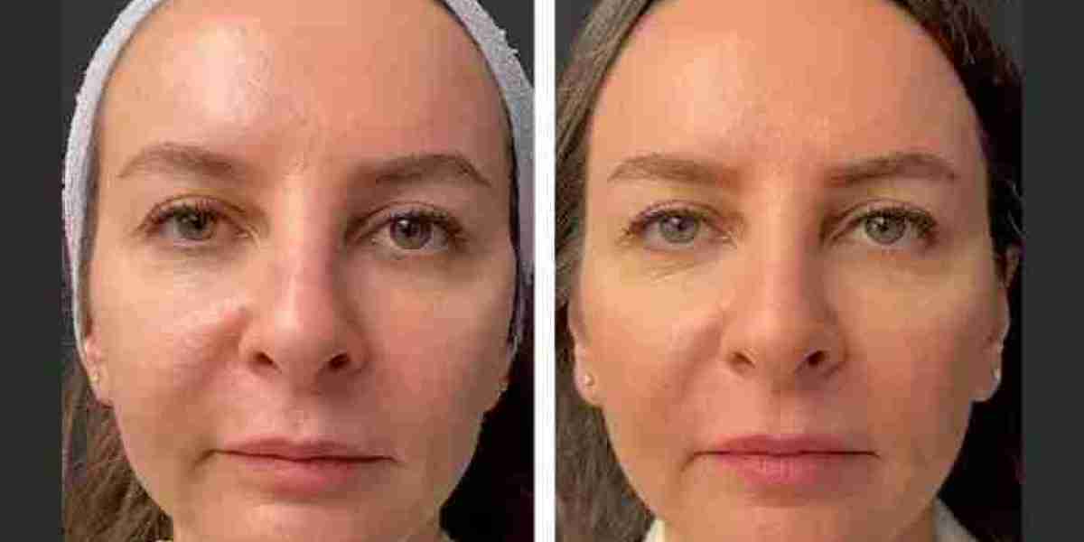 The Science Behind Mesotherapy Treatment in Dubai: How It Works