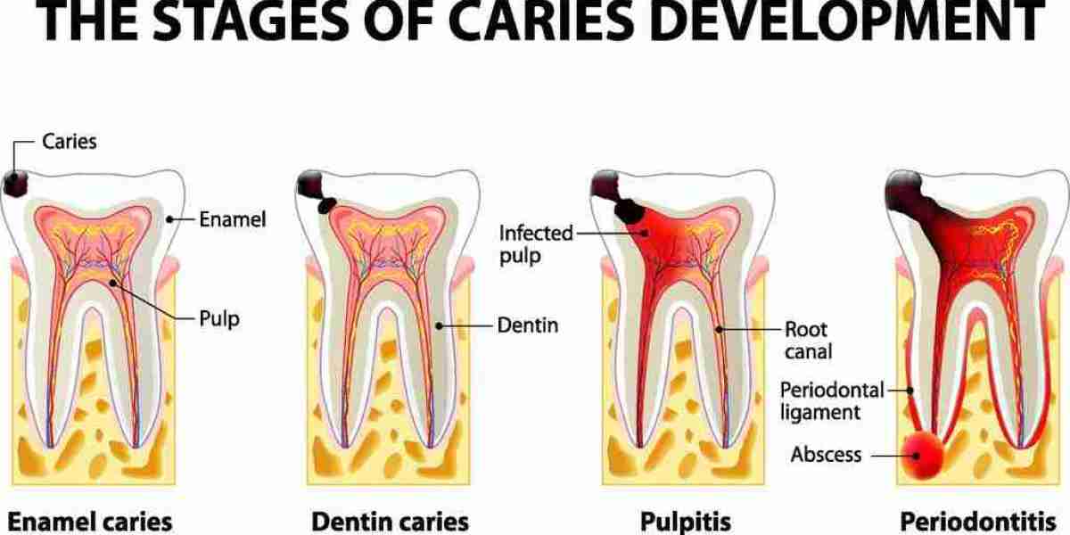Dental Caries: Causes, Prevention, and Treatment Options Explained