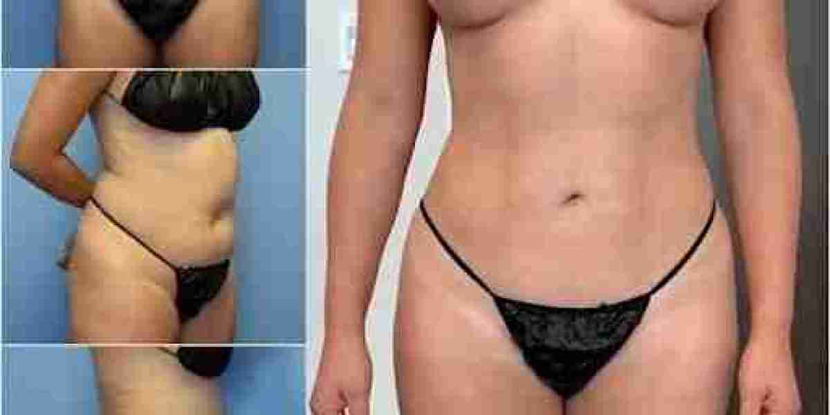 Body Transformation with the Best Doctors in Dubai for Body Contouring